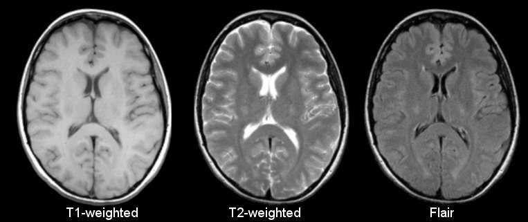 Anatomical MRI modalities, T1, T2 and FLAIR